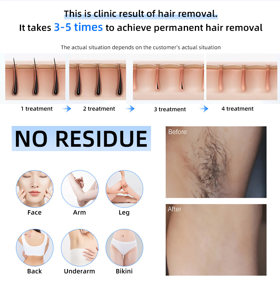 工場出荷時の価格 20000000   ビート 808nm  - Industrial Laser Hair Removal Machine のレビューと価格